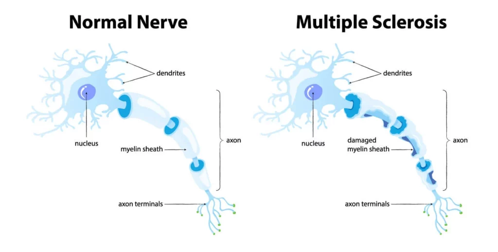 nervio normal vs esclerosis múltiple